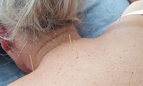 Do Acupuncture Needles Hurt?