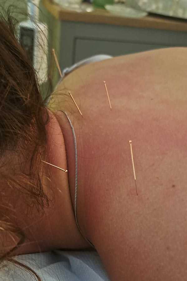Acupuncture