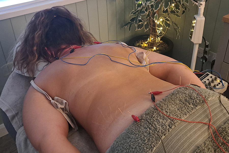 Acupuncture