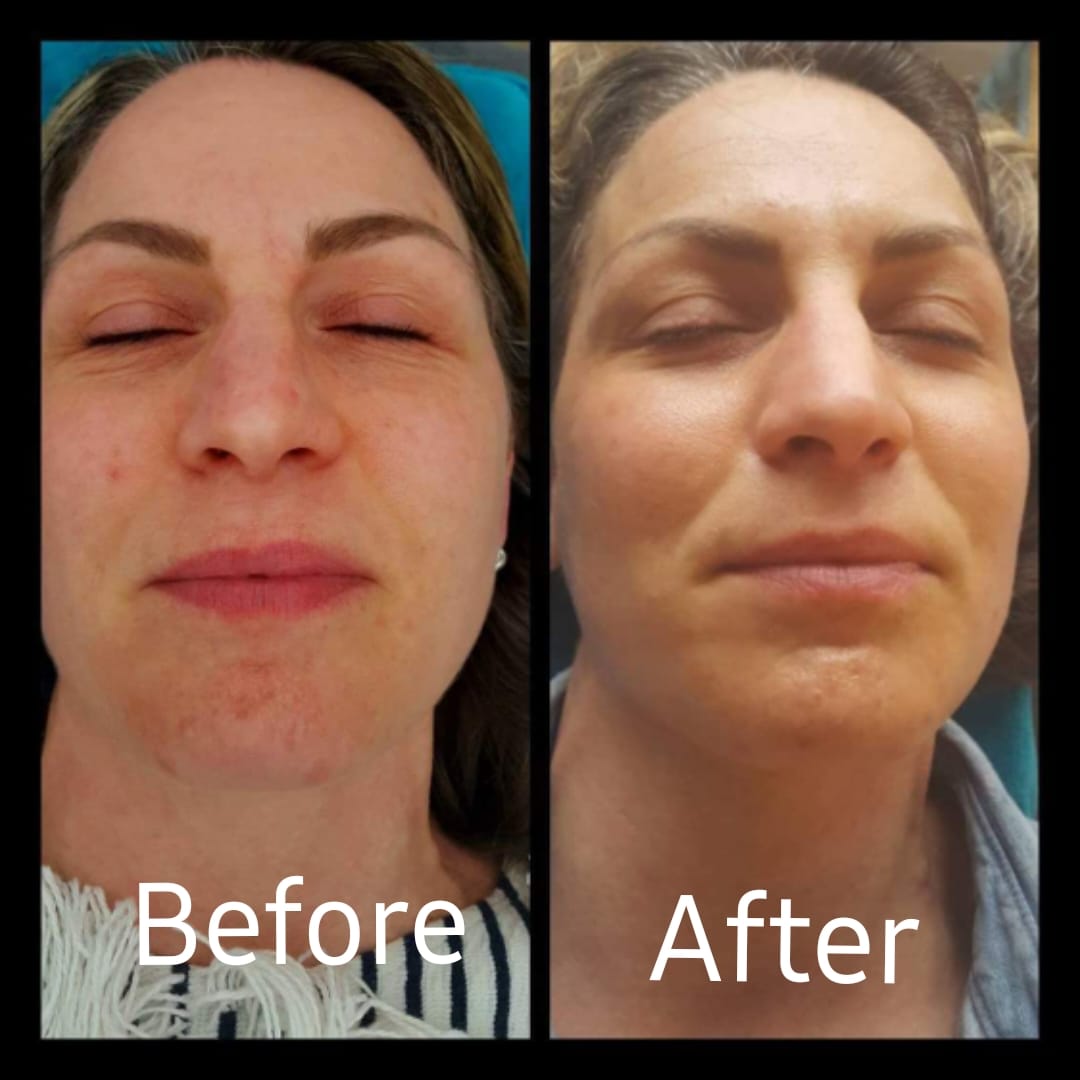Gua Sha Facial